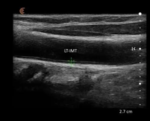 Ultrasound image of a carotid artery with the intima-media thickness measurement marked