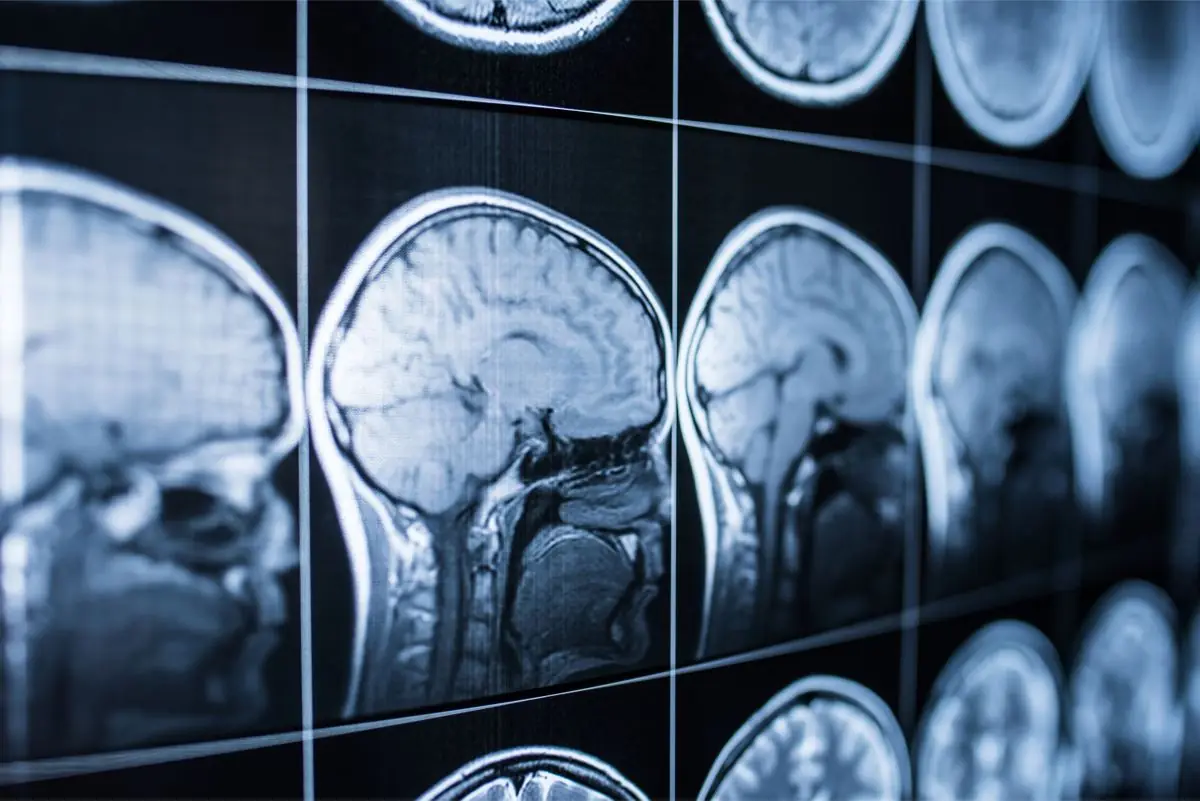 Feature image for the article: Why Does Traumatic Brain Injury Harm Your Gut?